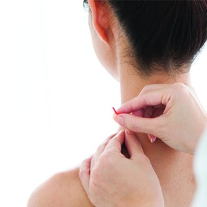 Acupuncture is becoming a more common treatment to promote overall wellness.